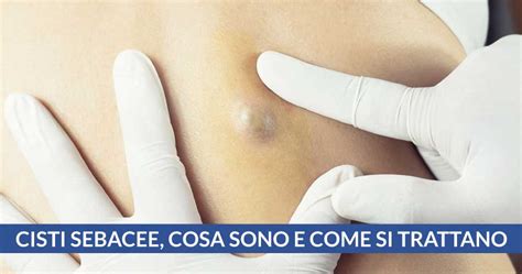 cisti sebacee come si cura.